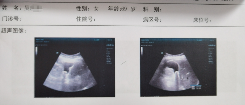 B超.png